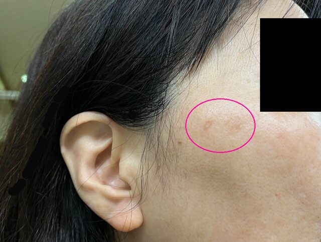 湘南美容クリニックで薄いシミにピコスポットを照射し、2週間後にシミの中心から白く抜けて薄れ始めた状態。まだ輪郭がうっすら残っている。